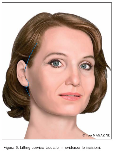 Lifting cervico-facciale: in evidenza le incisioni