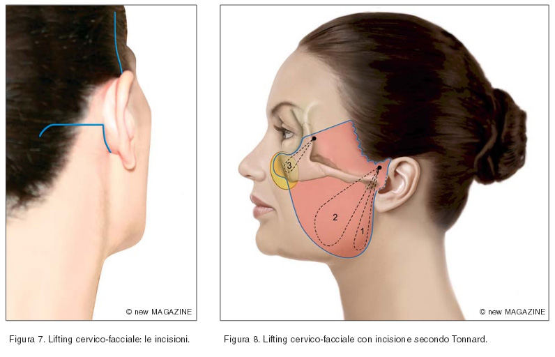 Lifting cervico-facciale: le incisioni e lifting cervico-facciale con incisione secondo Tonnard