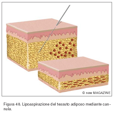 Lipoaspirazione del tessuto adiposo mediante cannula