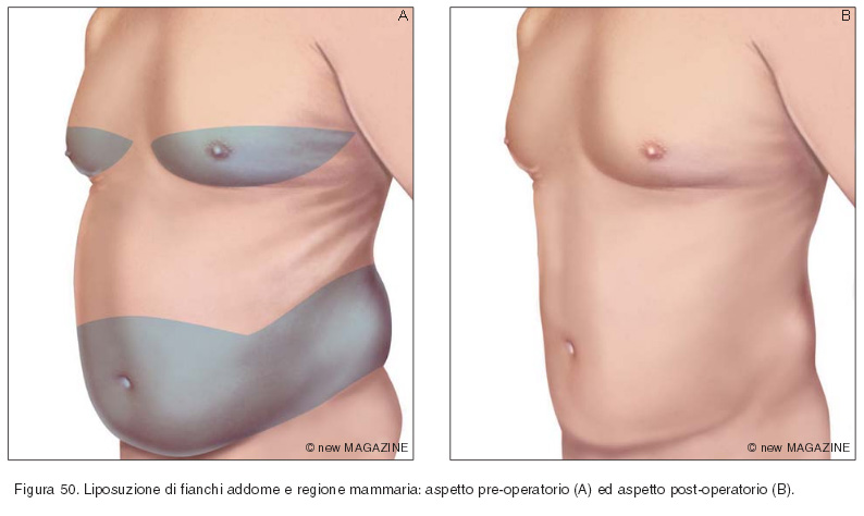 Liposuzione di fianchi addome e regione mammaria: aspetto pre-operatorio (A) ed aspetto post-operatorio (B)