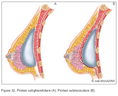 Protesi subghiandolare (A) e protesi submuscolare (B)