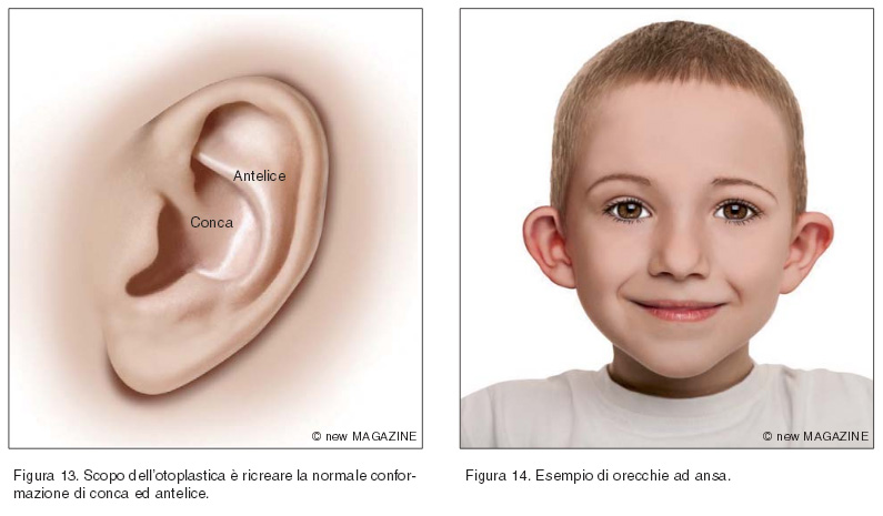 Scopo dell’otoplastica è ricreare la normale conformazione di conca ed antelice (figura 13); esempio di orecchie ad ansa (figura 14)
