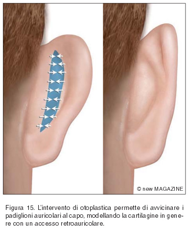 L’intervento di otoplastica permette di avvicinare i padiglioni auricolari al capo, modellando la cartilagine in genere con un accesso retroauricolare