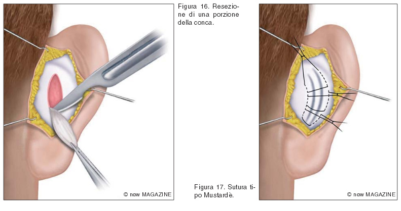 Resezione di una porzione della conca (figura 16) e sutura tipo Mustardè (figura 17)
