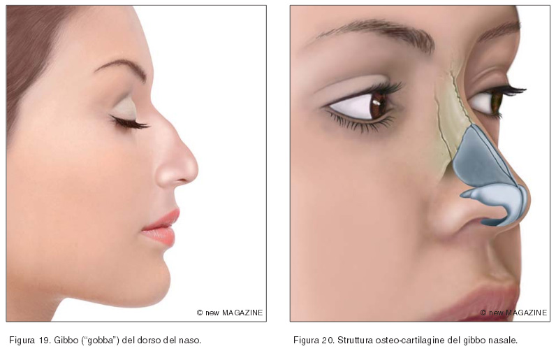 Gibbo (“gobba”) del dorso del naso (figura 19) e struttura osteo-cartilagine del gibbo nasale (figura 20)