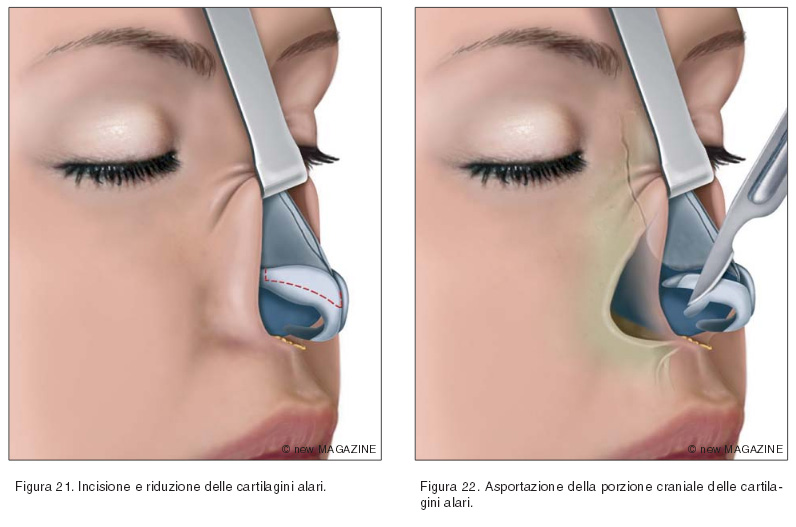 Incisione e riduzione delle cartilagini alari (figura 21) e asportazione della porzione craniale delle cartilagini alari (figura 22)