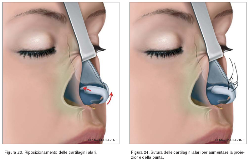Riposizionamento delle cartilagini alari (figura 23) e sutura delle cartilagini alari per aumentare la proiezione della punta (figura 24)